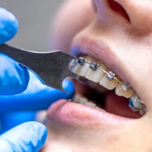 Braces & Aligners