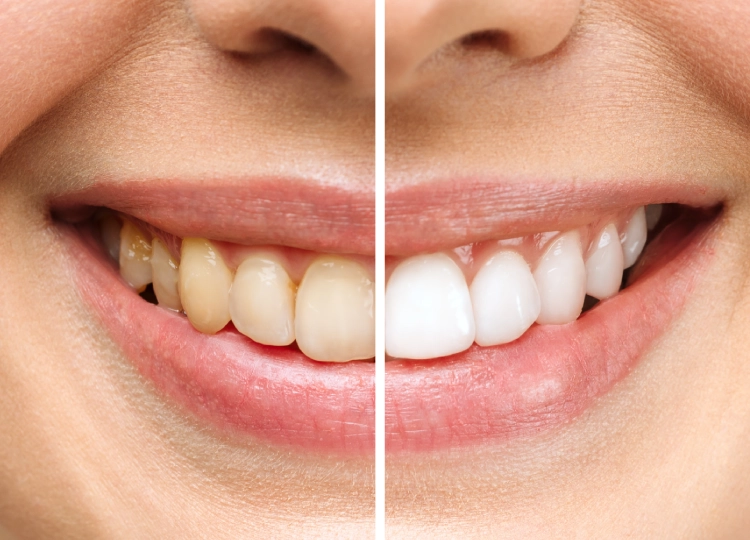 Teeth Whitening