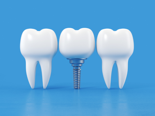 Dental implants in mumbai
