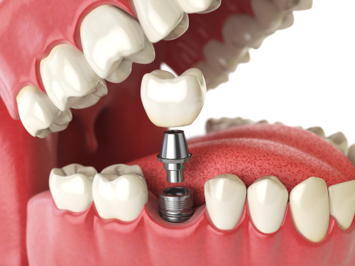 Dentist in Mira Rd offering immediate dental implants