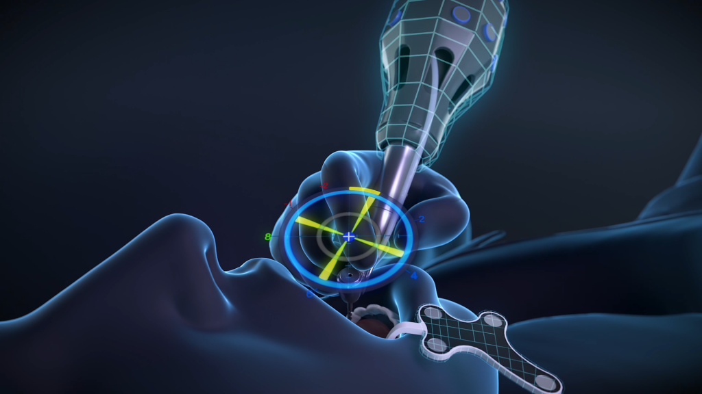 Robotic-assisted dental implant treatment by Dr. Swapnil Pande with IMPNAV navigation system