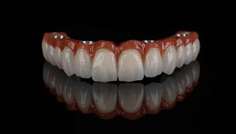 All-on-4 dental implants with CBCT, CAD-CAM and robotic implant technology