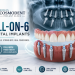 All-on-6 dental implants in Mumbai for full arch tooth replacement