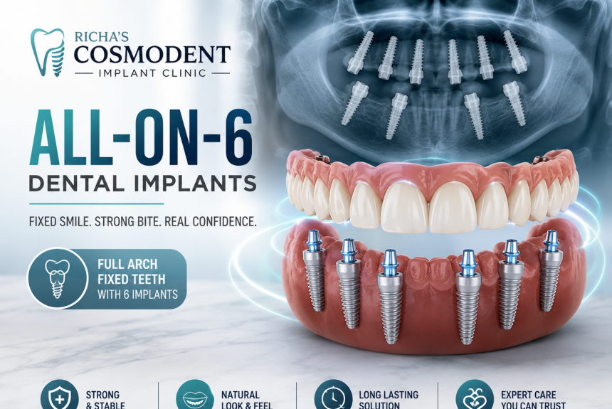 All-on-6 dental implants in Mumbai for full arch tooth replacement