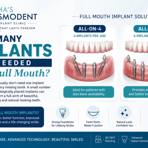 ChatGPT Image Aug 25, 2026, 04_35_25 PM How many implants are needed for a full mouth? Richa's Cosmodent infographic comparing All-on-4 with 4 implants per jaw and All-on-6 with 6 implants per jaw for full mouth dental implants.