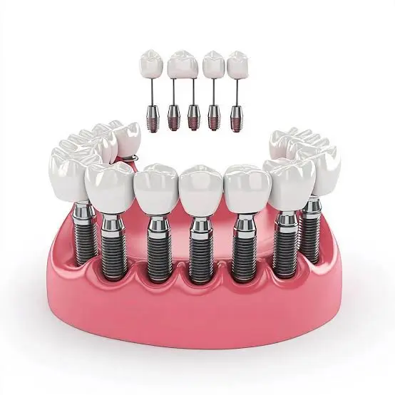 Missing teeth can affect the way you eat, speak and smile. Dental implants offer a stable and natural-looking way to replace missing teeth, from a single tooth to more extensive tooth replacement.
