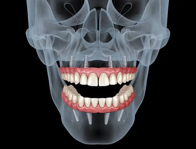 All-on-4 dental implant treatment for full arch tooth replacement